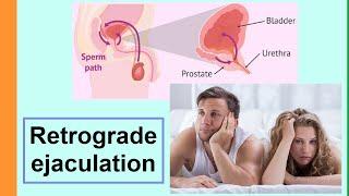 retrograde ejaculation