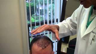 Reparative Hairline Excision Procedure to Remove Plug Grafts