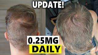 Finasteride Microdosing Update 2022!