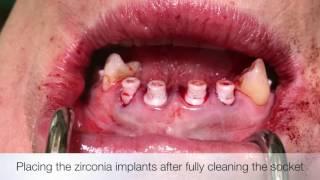 Immediate zirconia implants #3,4,7-10,13 - Keramik Sofortimplantate OK - Dr. Dominik Nischwitz