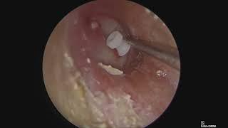 Endoscopic Myringotomy with Grommet insertion