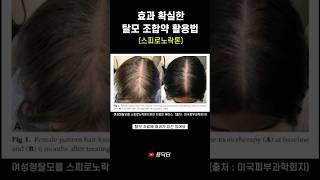 효과 좋은 탈모약, 조합약 먹어도 괜찮을까? (스피로노락톤, 알닥톤)