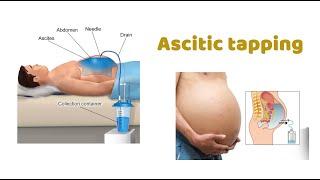 Ascitic Tap : Step-by-Step Guide / How to do Ascitic tap ?  Pigtail Drainage / Peritoneal Tapping