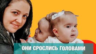Сиамские близнецы Бачинские-Мирошник. МЫ С МУЖЕМ СРАЗУ РЕШИЛИ, АБОРТА НЕ БУДЕТ.