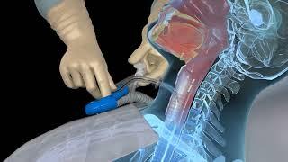 Open Suctioning with a Tracheostomy Tube - 3D animation