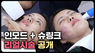 인모드, 슈링크 유니버스 이런분들 받으세요!  원리와 비교분석 총정리