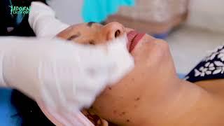 Carbon Laser Facial for Wrinkles and Dark Spot Remove | Adorn Laser Care