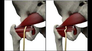 Sciatic Nerve Dynamic Ultrasound - Includes Obturator Gemellus Piriformis Quadratus Femoris