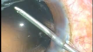 Corneal Topography assisted "Refractive Cataract Surgery"