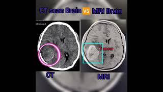 CT scan Brain  MRI Brain/Pathology detailing #aiims