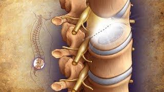 Mayo Clinic Minute: Minimally invasive surgery solutions for bad backs