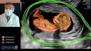 Confirming FETAL SEXING. Gestation 14 weeks.