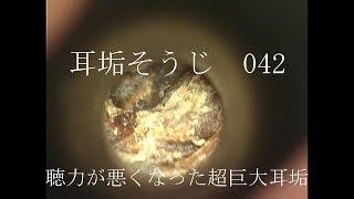 耳垢そうじ/聞こえが悪くなった超巨大な耳垢/042