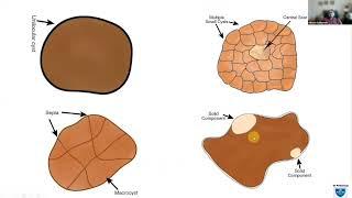 Lectures from the Lockdown #2. Dr. Vikram Deshpande talks on EUS guided FNAC: Cysts of the Pancreas