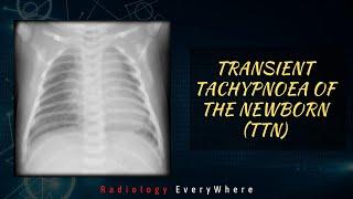 Transient tachypnea of the newborn | TTN | Radiology Everywhere