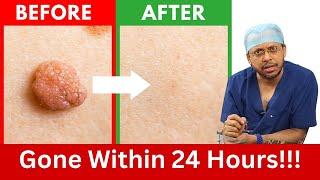 How to Rid Skin Tags and Warts Within 24 Hours - Dr. Sanjay Sarkar on Skin Tag Removal