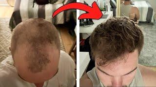 How I Fixed My Hairline Naturally (NO SURGERY NEEDED)