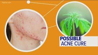 Can CBD oil really help with acne?