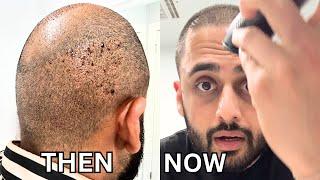 SHAVING MY HEAD BALD 3 Years AFTER HAIR TRANSPLANT