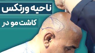 کاشت مو در ناحیه ورتکس:رضایت زیباجو از کاشت ناحیه ورتکس