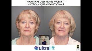 Deep Plane Preservation Facelift (High SMAS) - My Rationale and What Patients Need to Know