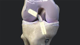 Arthrex BioACL™ Technique