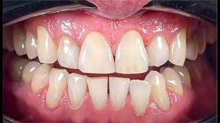 Dental composite Zenchroma from president dental Ruslan Mansurov