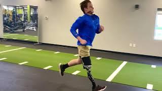 Kyle, Knee Disarticulate Amputee on PPS Prosthetic Socket