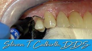 Class Five (Gingival Facial) Composite - Dental Minute with Steven T. Cutbirth, DDS