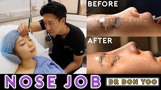 Asian rhinoplasty with Rib Cartilage and DCF | Recovery after Asian Nose Job Surgery