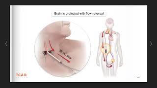 Transcarotid Artery Revascularization (TCAR) procedure