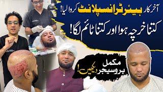 Hafiz Ahmed Hair Transplant Complete Procedure | Hafiz Ahmed