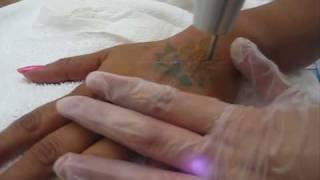 Laser Tattoo Removal - Hand