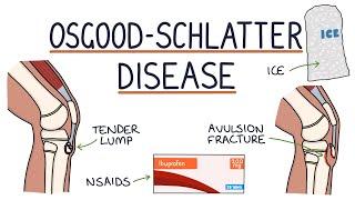 Understanding Osgood-Schlatter Disease