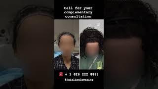 Female Hairline lowering using FUE Hair Transplant method in Los Angeles 6 month progress 50% growt