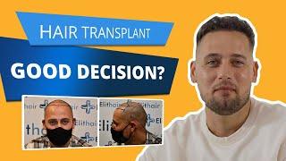 HAIR Transplant Turkey Experience I Elithair