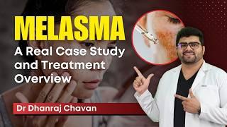 Melasma Treatment Journey: Real Case Study and Expert Insights | Successful treatment | ClearSkin