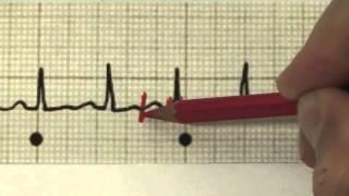 EKG für Pflege Teil 12 - tachykarder Sinusrhythmus interpretieren