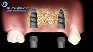 Patient Treatment Videos: Implant Bridge