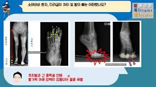 {발!톡!}, 소아마비 환자의 까치발과 중족골통, 수술적치료 사례