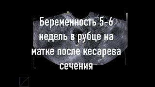 Беременность 5-6 недель в рубце на матке после кесарева сечения