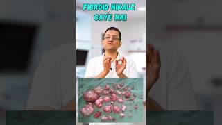 36 fibroids removed from a single lady | Non surgical treatment of fibroids | Dr. Gaurav Gangwani |