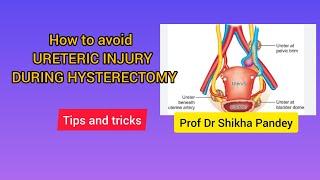 AvoidUreteric injury in Hysterectomy and litigations, precautions @saisamarthgyneclasses