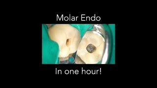 Molar Endo in one hour