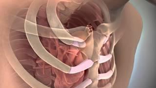 3d medical animation first rib fracture