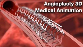 Angioplasty - Medical animation