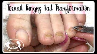 Pedicure Tutorial: Thinning Thick Toenail Fungus Nail Transformation ️