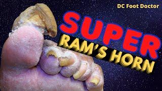 Super Ram's Horn Toenail: Super Challenging