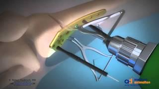 Distal Femoral Osteotomy ANIMATION - Dr. S. Robert Rozbruch LIMB LENGTHENING