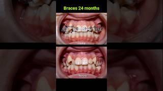 Braces correct all cases of crooked teeth #braces #orthodontist #bracket